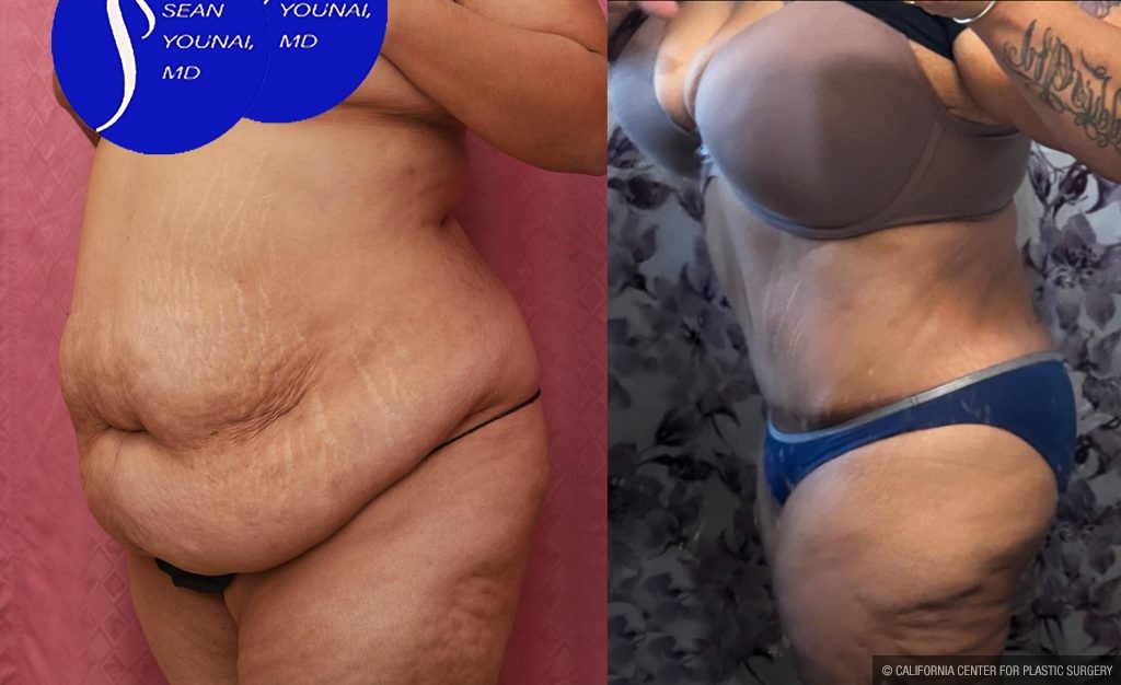 Tummy Tuck (Abdominoplasty) Super Plus Size Before & After Patient #15062