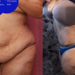 Tummy Tuck (Abdominoplasty) Super Plus Size Before & After Patient #15062