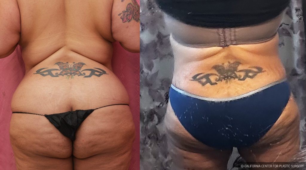 Tummy Tuck (Abdominoplasty) Super Plus Size Before & After Patient #15062