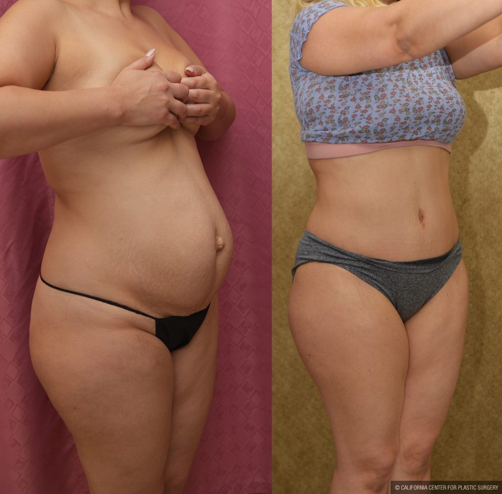 Tummy Tuck (Abdominoplasty) Small Size Before & After Patient #15061