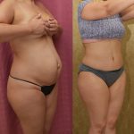 Tummy Tuck (Abdominoplasty) Small Size Before & After Patient #15061
